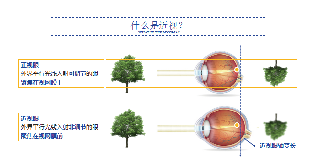 1622019932110862.png 2.近视是怎么形成的?.png